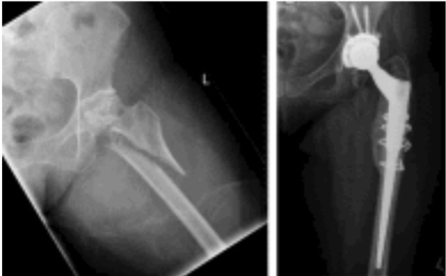 Trochanteric fractures in older patients: hip prosthetic surgery ma be ...